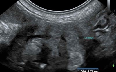 A Cool Kidney